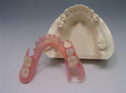 ノンクラスプデンチャー